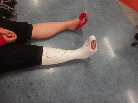 castgirls: webfinds: broken toe casts