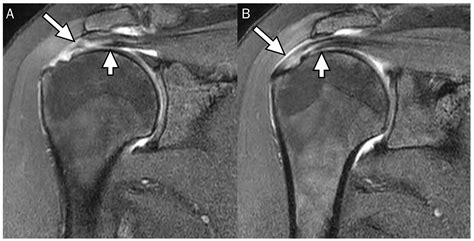 Diagnostics | Free Full-Text | Delaminated Tears of the Rotator Cuff: MRI Interpretation with ...