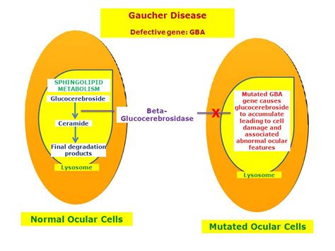 Gaucher Disease | Hereditary Ocular Diseases