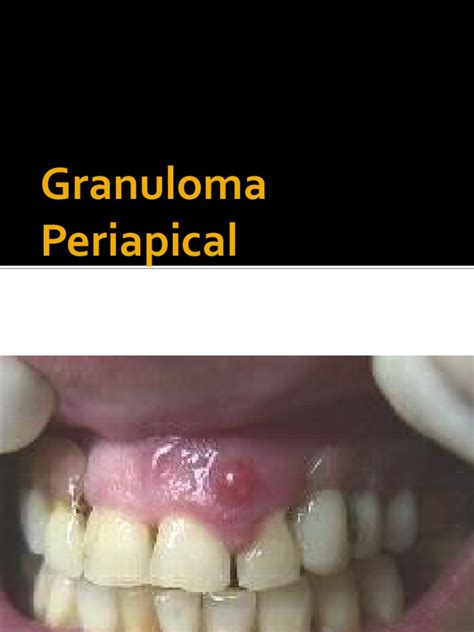 Granuloma Periapical | PDF