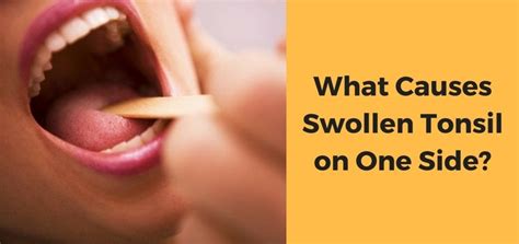 Swollen Tonsil on One Side: Possible Causes and Home Remedies