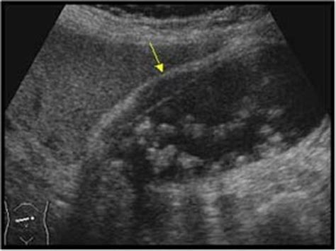 Abdomen and retroperitoneum | 1.2 Gallbladder and bile ducts : Case 1.2 ...