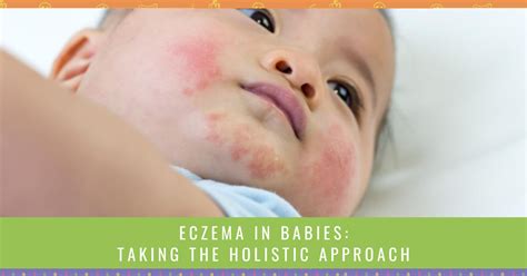 Baby Eczema: What Does It Look Like? AND How To Treat It, 56% OFF