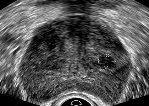 Transverse transrectal ultrasound image of the mid prostate. There is a... | Download Scientific ...