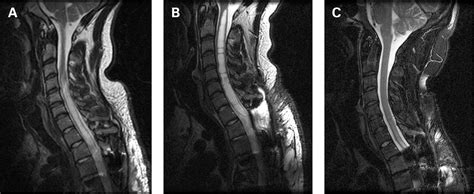 Multiseptated post-traumatic cervicothoracic syrinx treated by two anatomically distant syringo ...