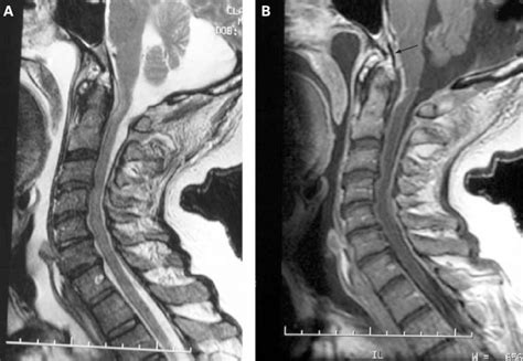 Epidural Abscess Mri Lumbar