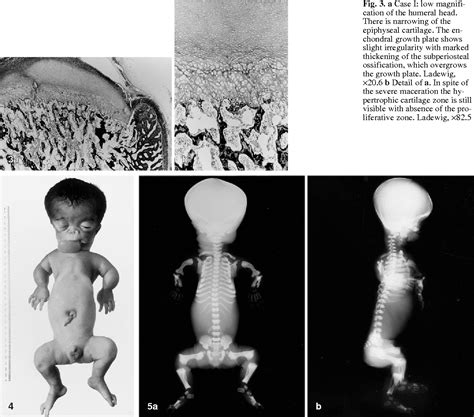 Chondrodysplasia, blomstrand type | Semantic Scholar