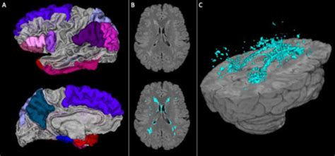 Brains of Black Americans age faster, study finds