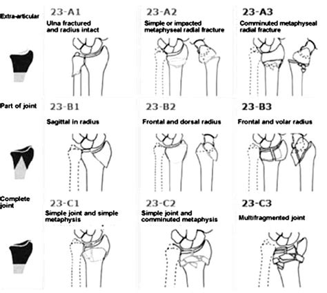 AO Classification for the fractures of distal radius. 5 | Download Scientific Diagram