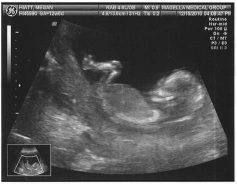 The Spamdrew Family: 13 Week Ultrasound