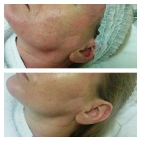 Microdermabrasion Treatments - Southampton Skin Clinic