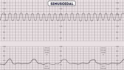 How to Read a CTG | CTG Interpretation | Geeky Medics