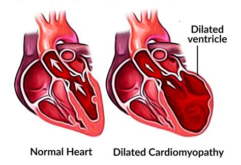 Dilated cardiomyopathy (DCM) in dogs and cats - Greenside Animal Hospital - Greenside Animal ...