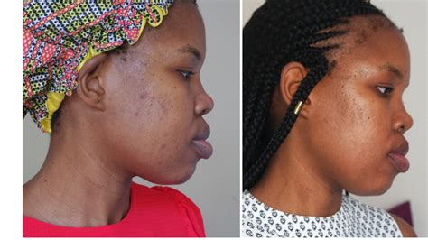 how i faded my hyperpigmentation - ByLungi