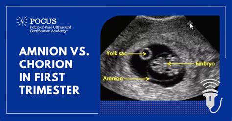 Amnion vs Chorion in the 1st Trimester | POCUS Resources & Case Studies | POCUS.org