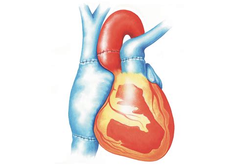 How does a heart transplant work? – How It Works