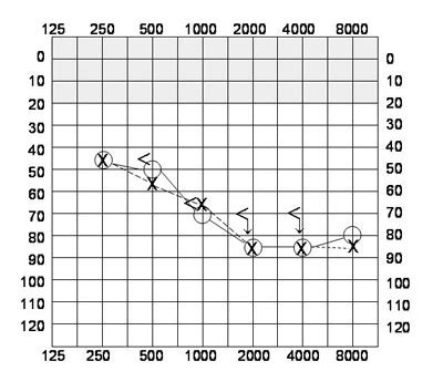 Audiograms - MyDr.com.au