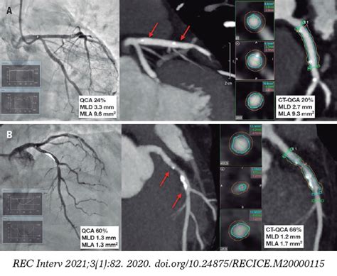 Magmaris bioresorbable stent: cardiac CT follow-up | Images in cardiology