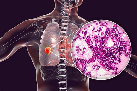 Proteomic map of human lung adenocarcinoma revealed