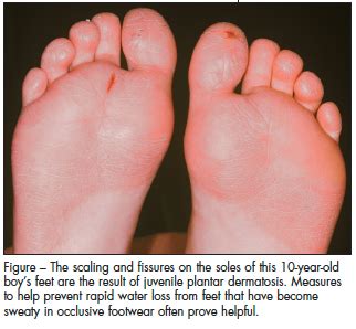 Juvenile Plantar Dermatosis: Readers’ Remedies | Consultant360