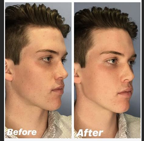 We see a lot of requests to enhance the shape of the jawline. For men we they often want a more ...