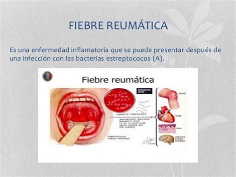 AsisMed: Fiebre reumática