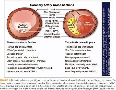 Mechanisms of erosion of atherosclerotic plaques. | Semantic Scholar