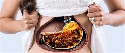 LiveSmart: Minimally Invasive LINX Procedure Offers Relief from Reflux - St. Peter's Health ...