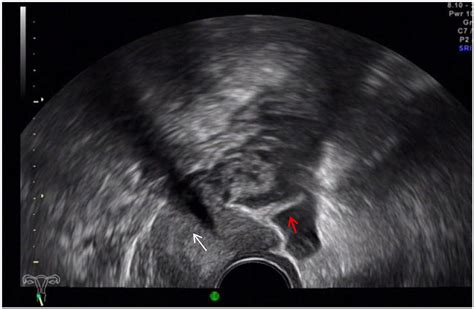 Frontiers | Diagnosis of Deep Infiltrating Endometriosis Using Transvaginal Ultrasonography