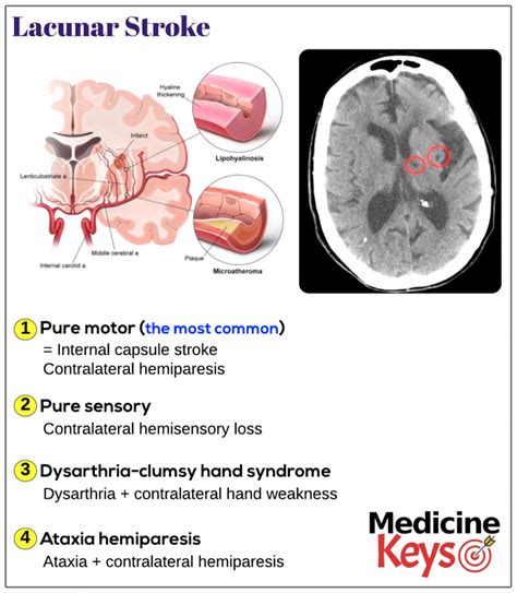 Lacunar stroke - Medicine Keys for MRCPs