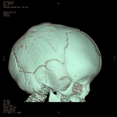 Craniosynostosis - dolichocephalic head | Radiology Case | Radiopaedia.org