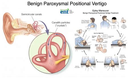 Benign Paroxysmal Positional Vertigo : Clinical Characteristics Of Benign Paroxysmal Positional ...