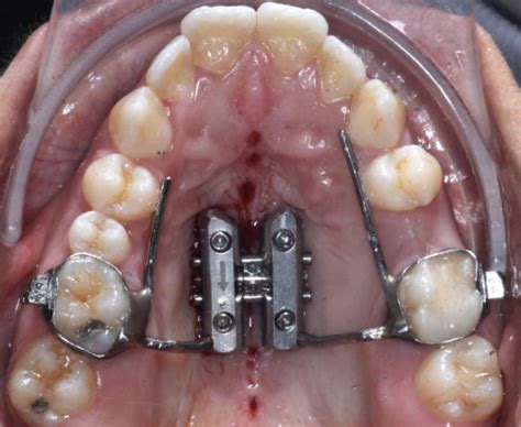 Rapid Palatal Expander: Pro's and Con's - Elizabeth Caughey DDSElizabeth Caughey DDS