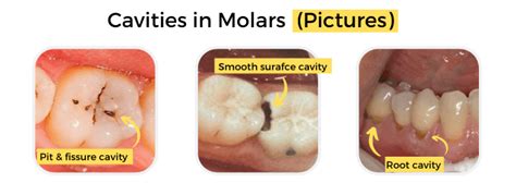 Cavities in Molars: Symptoms, Causes, & Treatment - Share Dental Care