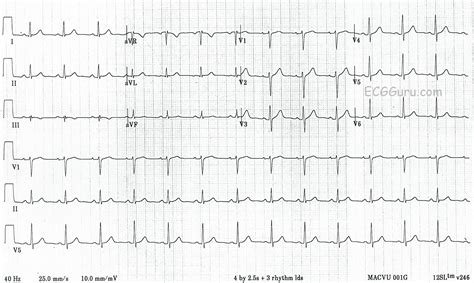 Normal 12-Lead ECG With Rhythm Strips | ECG Guru - Instructor Resources