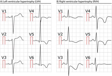 Right ventricular hypertrophy (RVH): ECG criteria & clinical ...