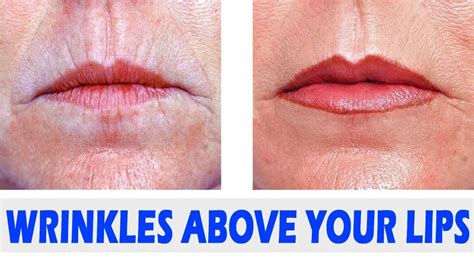 How To Get Rid Of Wrinkles Above Your Lips | Natural Remedies for Wrinkles Above Lips - YouTube ...