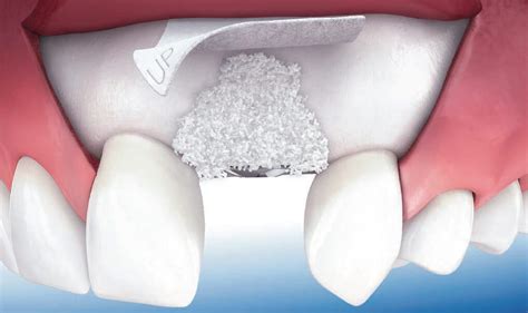 Bone Graft For Dental Implant Infection at Allison Sutherland blog