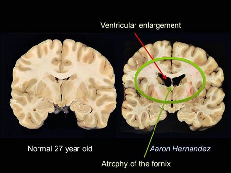 REPORT: Photos Reveal Aaron Hernandez Had Worst CTE Of Anyone His Age