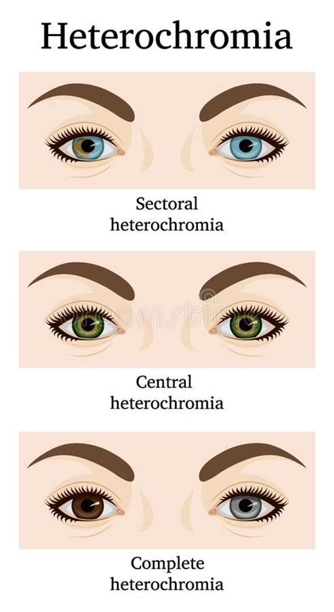 Illustration of Heterochromia iridum. Illustration of three types of ...