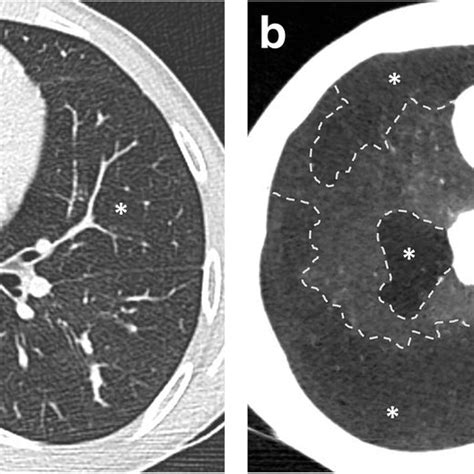 Centrilobular nodules in high resolution computed tomography of the... | Download Scientific Diagram