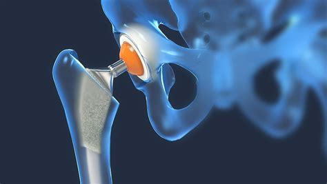 Anterior Hip Replacement scar | Bikini Hip Replacement