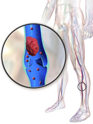 What Is a Thrombus? - Definition & Formation | Study.com