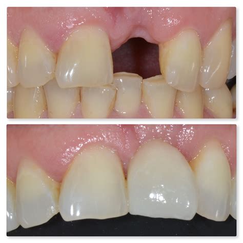 Bone loss and loose teeth - Successful Dental Implant treatment protocol