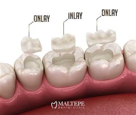 Composite Inlays and Onlays: A Durable and Affordable Option - Maltepe Dental Clinic