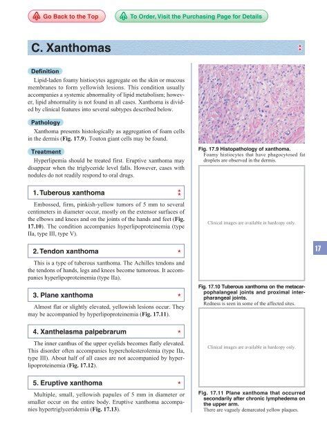 1.Tuberous xanthoma