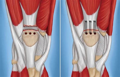 Ruptured quadriceps tendon causes, symptoms, diagnosis, treatment & recovery