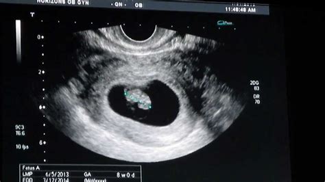 8 Weeks Ultrasound - YouTube