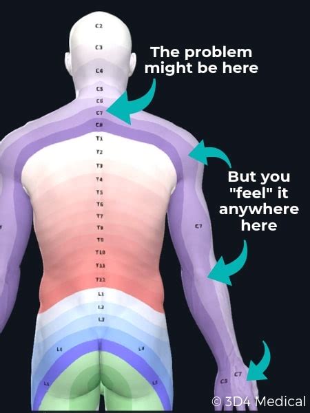 How to Know if you have a Neck Disc Herniation - Geelong Osteopaths