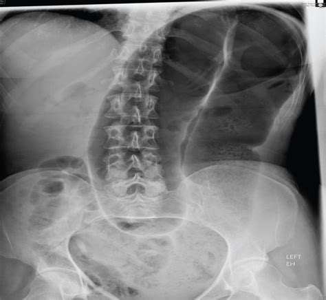 Volvulus X Ray Omega Sign